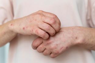 
Dia Mundial da Alergia: conheça os principais tipos
