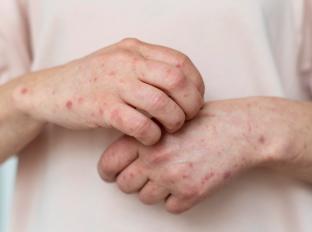 
Dia Mundial da Alergia: conheça os principais tipos
