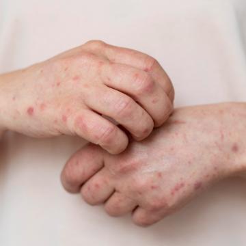 
Dia Mundial da Alergia: conheça os principais tipos
